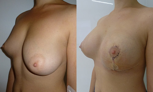Ольга до и после благотворительной операции, вид сбоку