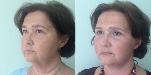 эндоскопическая подтяжка лица – фото до и после 