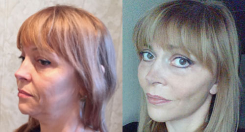 СМАС-лифтинг, фото до и после (доктор Борисенко)