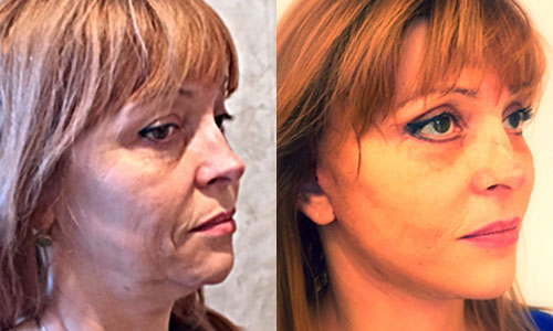 пациентка доктора Борисенко до и после СМАС-подтяжки лица