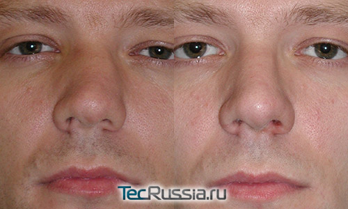 до и после хирургической коррекции сломанного носа