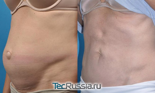 фото до и после операции по удалению диастаза и пупочной грыжи