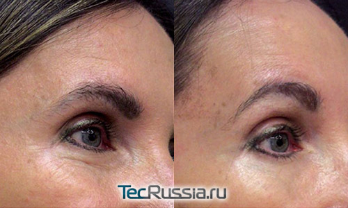 радиоволновой термолифтинг кожи вокруг глаз – фото до и после процедуры