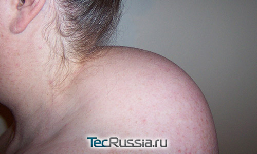 жировые отложения (вдовий горб) на шее у женщины