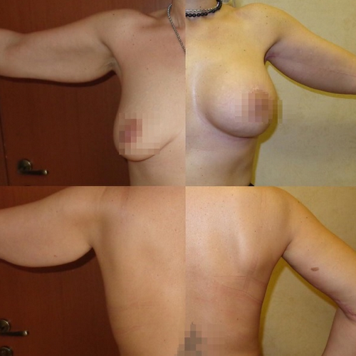 фото до и после операций по подтяжке рук и груди