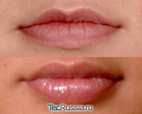 Плюриаль для увеличения губ – фото до и после