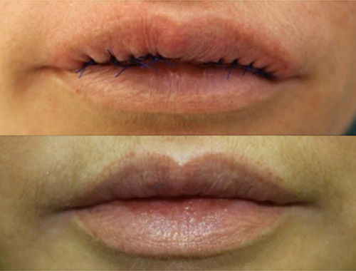 удаление биополимера из губ, фото до и после
