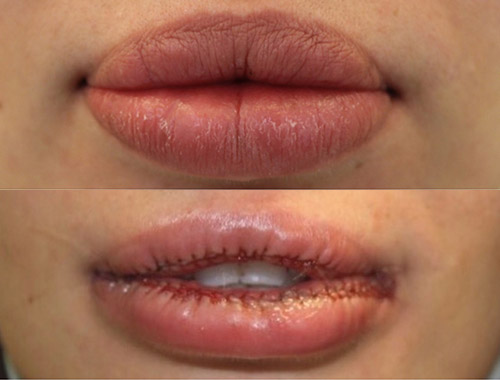 удаление силикона из губ, фото до и после операции