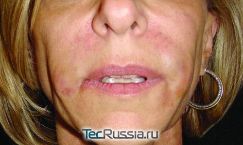 аллергия на филлер галуроновой кислоты – отеки на лице и узелки под кожей