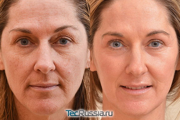 фото до лазерной шлифовки лица и после полного восстановления кожи
