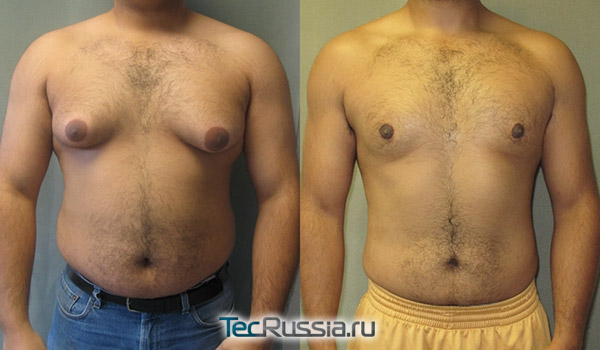 фото до и после операции при гинекомастии, вид спереди
