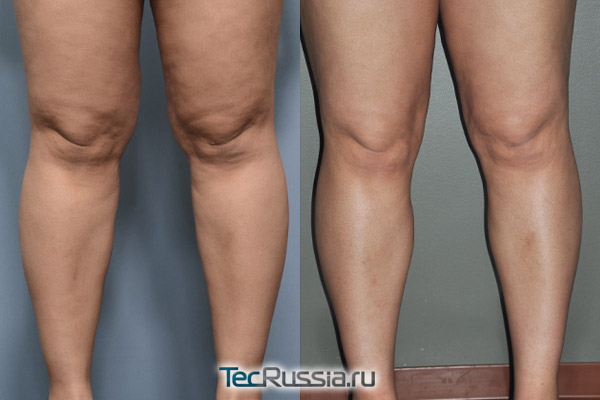 фото до и после липосакции коленей и голеней