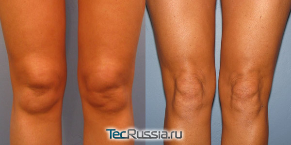 удаление жира с передней части колена лазером, фото до и после
