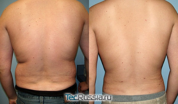 липосакция нижней части спины у мужчины