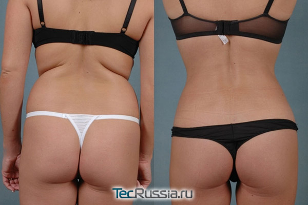 лазерная липосакция спины, фото до и после