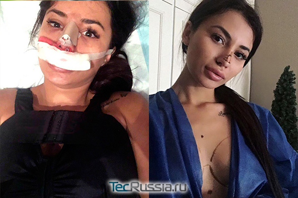 Лилия Четрару до и после пластики носа