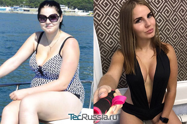 Анна Еременко (Большая Сушка) до и после пластики