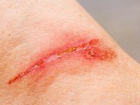 Что делать, если воспалился рубец: правильное лечение проблемных шрамов