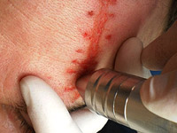 Механическая дермабразия рубцов: терпим боль ради гладкой кожи