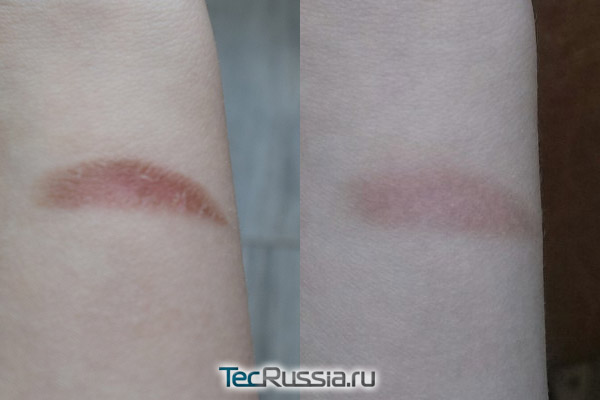 фото до и после курса Имоферазы для удаления следов ожога на коже