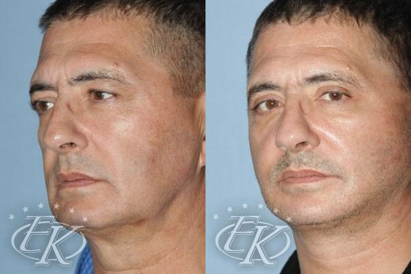 Александр Мсников до и после операции по подтяжке лица