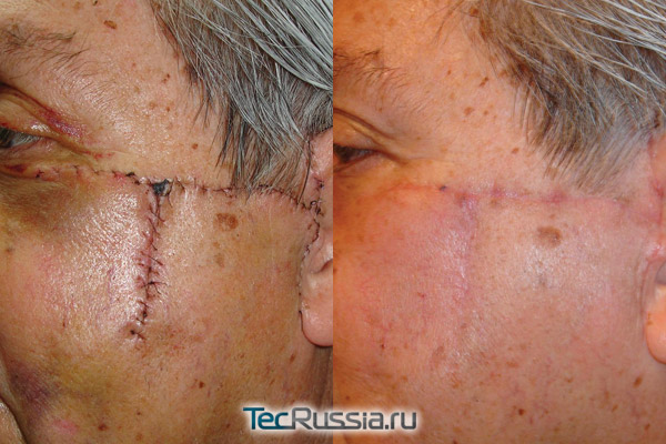 фото до и после лечения рубца на лице
