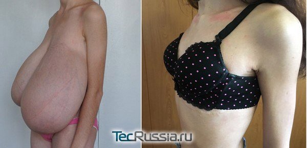 до и после уменьшения груди