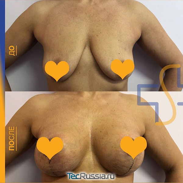 фото до и после мастопексии, хирург Ведров О.В.