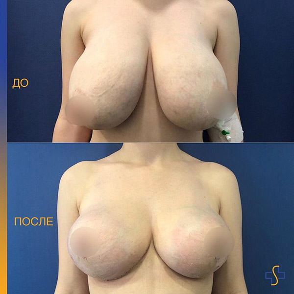 грудь очень большого размера до и после операции по уменьшению