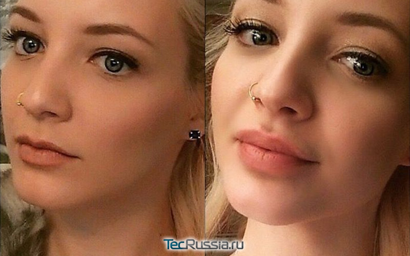 фото до и после удачного увеличения губ филлерами