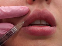 Как ухаживать за губами после филлеров: правила и полезные рекомендации
