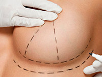 Увеличение и подтяжка груди гиалуроновой кислотой: что нужно знать об этой процедуре