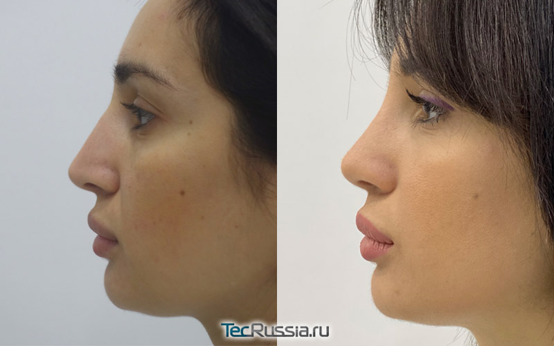 фото до и после коррекции носа