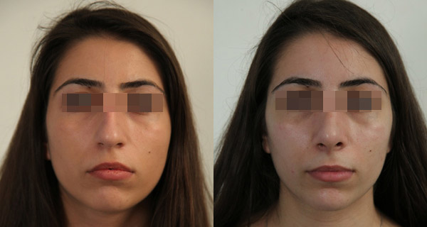 Хирург Кибишева Амина, фото до и после ринопластики