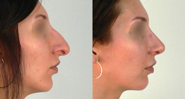 Фото до и после пластики носа