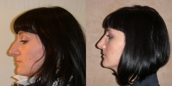 Фото до и после ринопластики у доктора Меладзе З.А.
