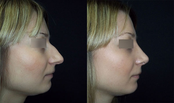 ринопластика длинного носа с горбинкой, вид сбоку, хирург Т.А.Алексанян