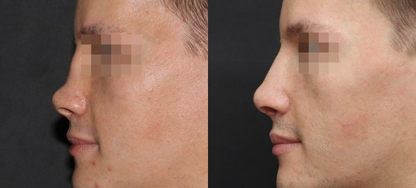 Восстановление носа после перелома, вид сбоку, хирург Григорянц В.С.