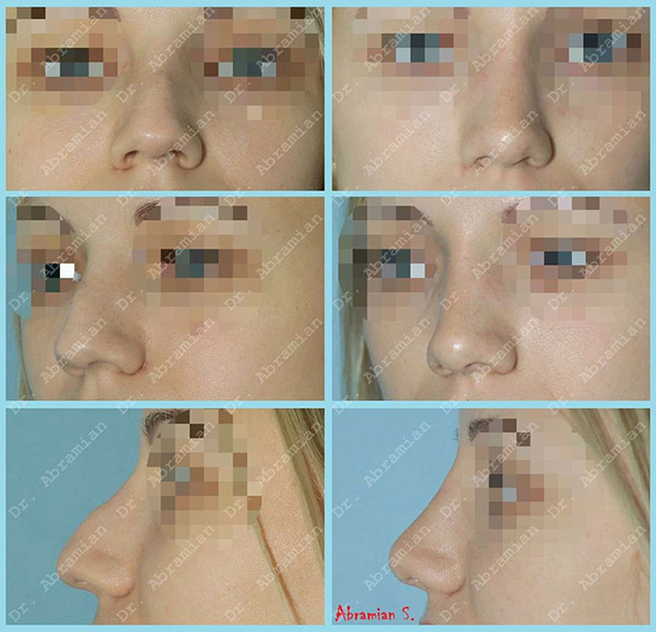 Ринопластика - фото до и после операции, хирург Абрамян С.М.