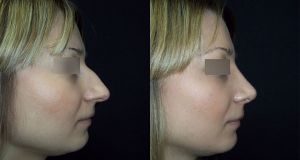ринопластика длинного носа с горбинкой, вид сбоку, хирург Т.А.Алексанян