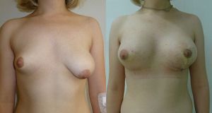 фото до и после увеличения груди имплантами разного размера, хирург Сергеев И.В.