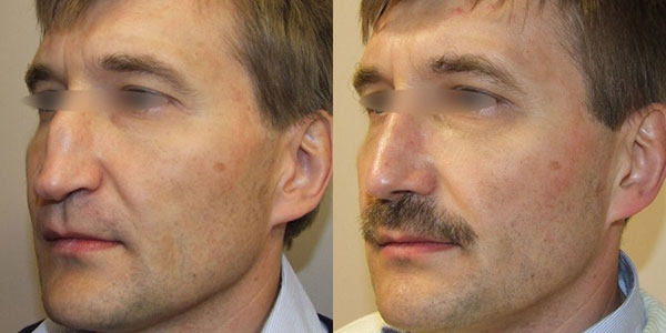 До и после пластики носа – удалена горбинка, приподнят кончик