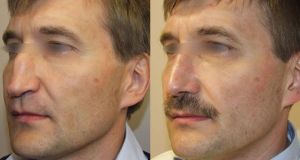 До и после пластики носа – удалена горбинка, приподнят кончик