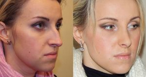 Коррекция горбинки и удаление нависающего кончика носа
