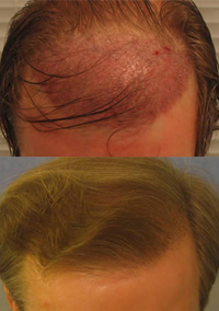 Пересадка (трансплантация) волос