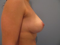 Фото после подтяжки груди