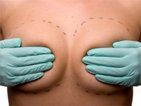 Подтяжка груди: фото до и после