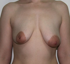 Фото до подтяжки груди