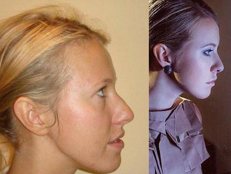 Ксения Собчак – фото до и после пластических операций