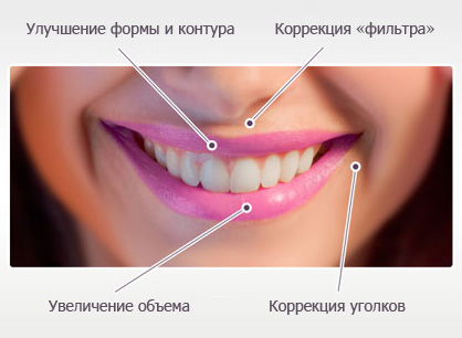 Ювидерм Ультра Смайл (Juviderm Ultra Smile)